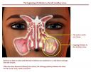 beginingmaxillaryinfectionlarge.jpg